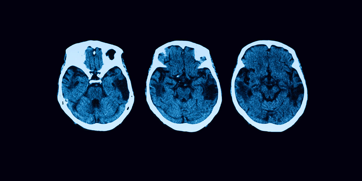 CT (computed tomography) scan to visualize brain structure of ischemic stroke patient and diagnose damage due to ischemic stroke.